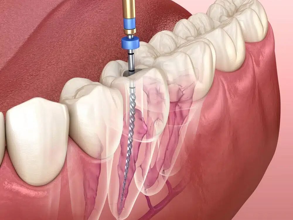 Root Canal Treatment