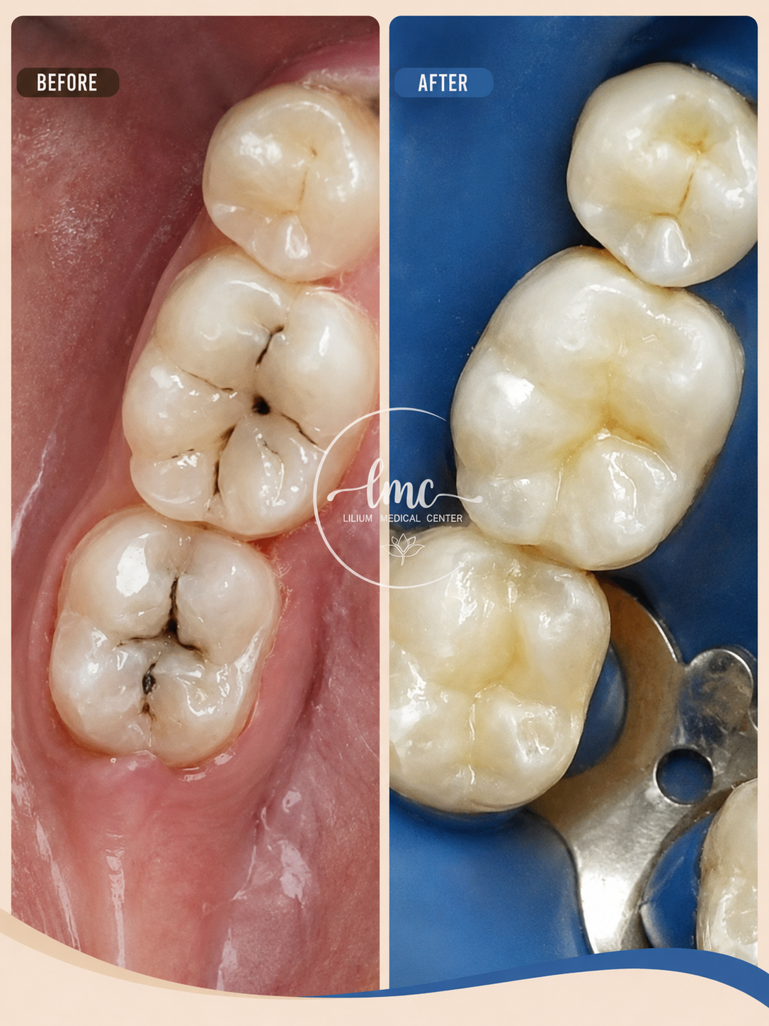 Dental before and after treatment result at Lilium Medical Center in Ajman