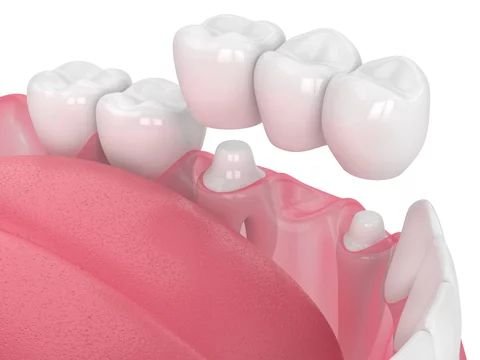 Dental bridges in Ajman at Lilium Medical Center