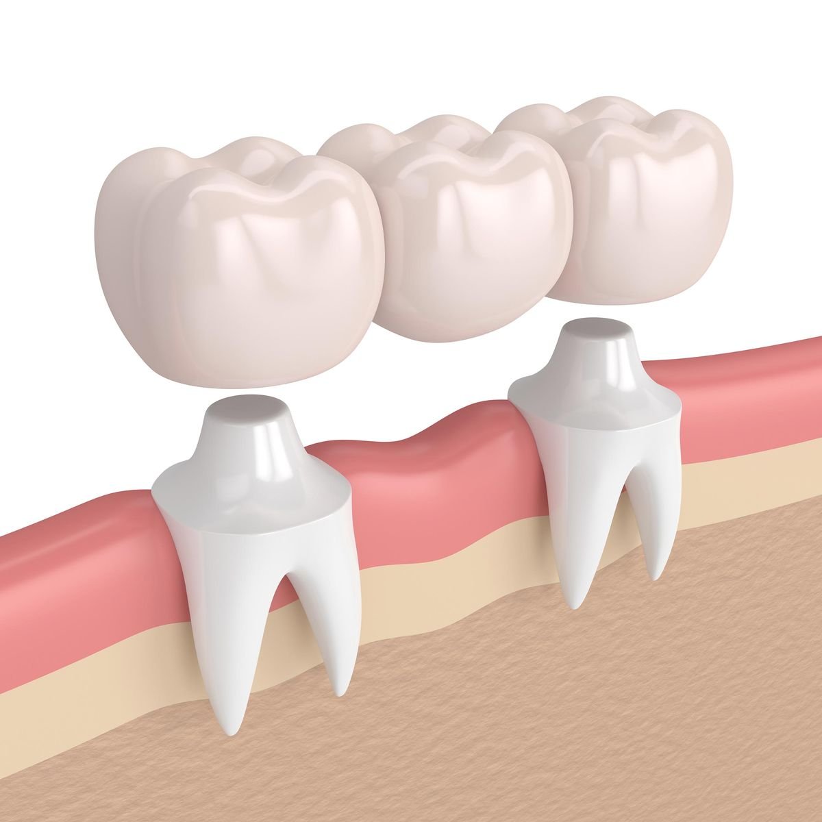 Dental bridge restoration for replacing missing teeth