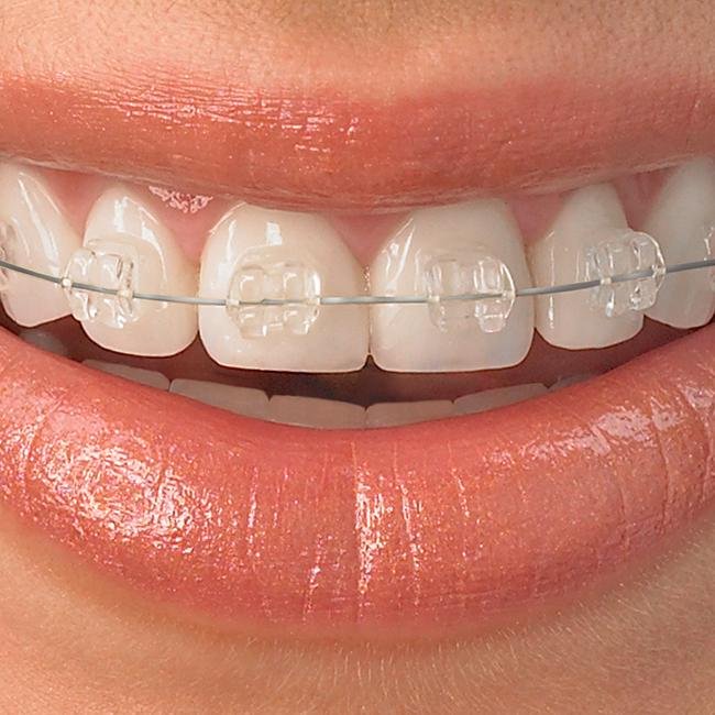 Ceramic braces treatment in Ajman at Lilium Medical Center