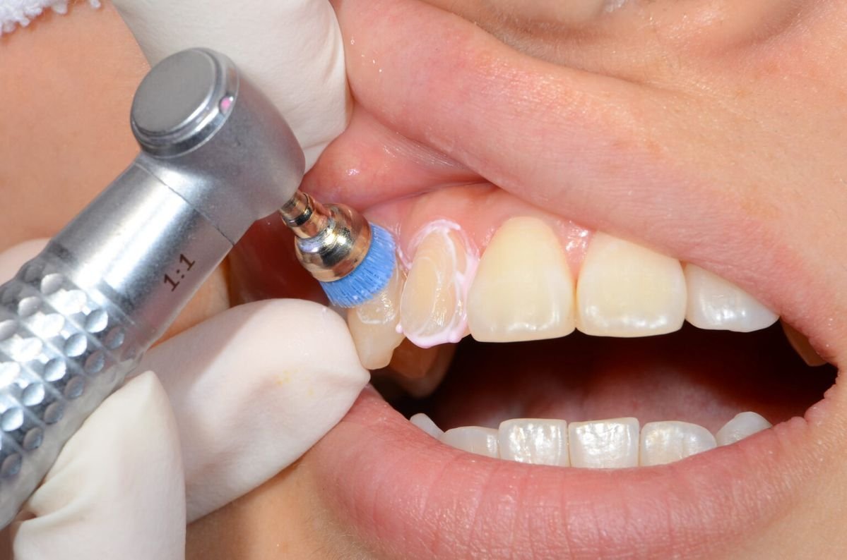 Teeth cleaning in Ajman at Lilium Medical Center