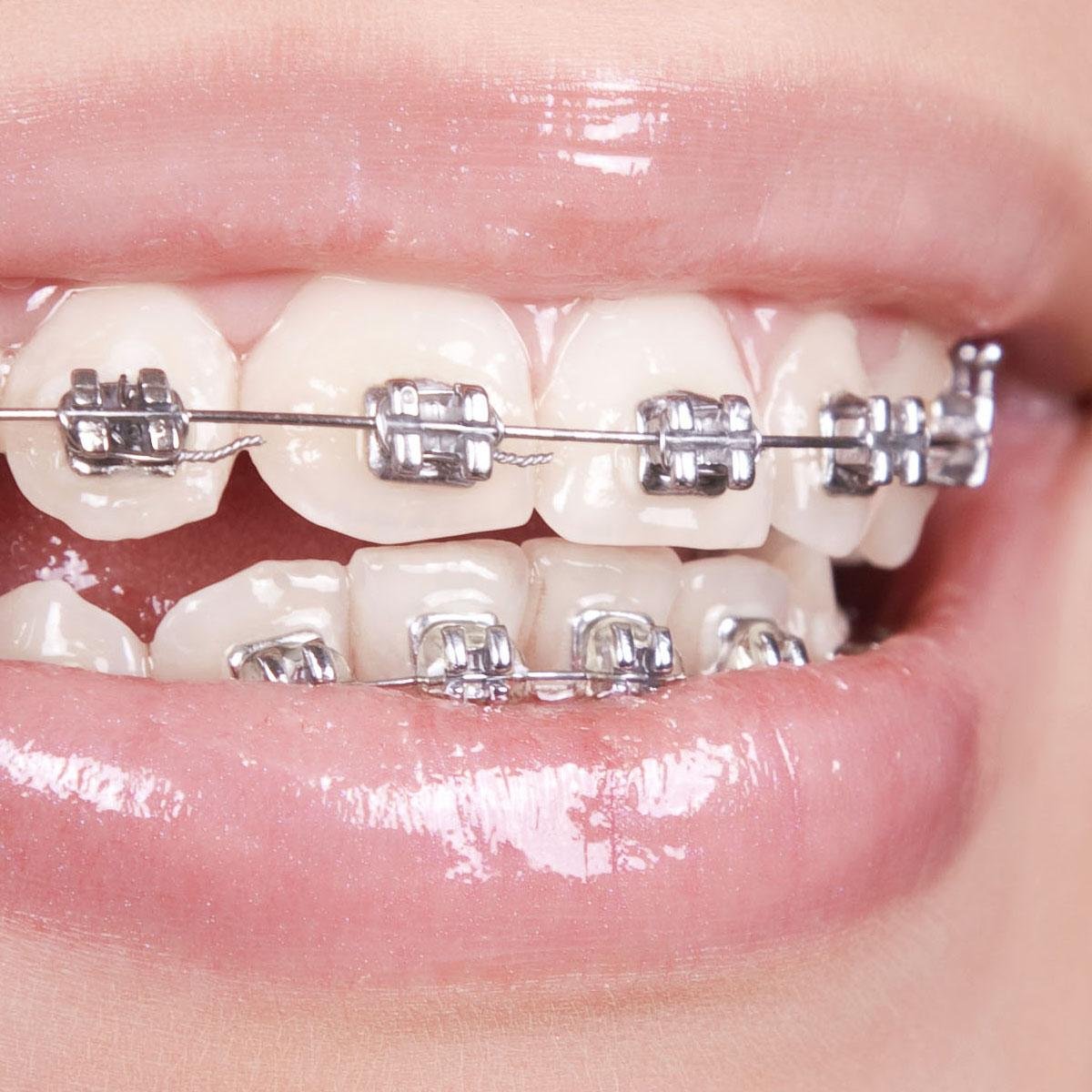 Traditional braces treatment in Ajman at Lilium Medical Center